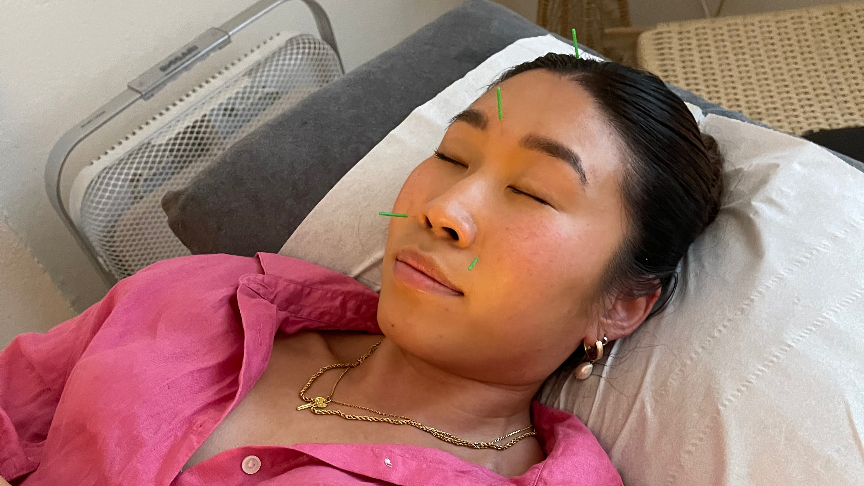 Botox Through the Lens of Traditional Chinese Medicine